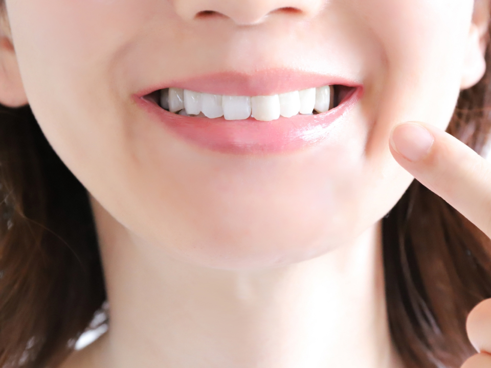 マウスピース型矯正