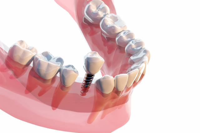 インプラント治療とは？